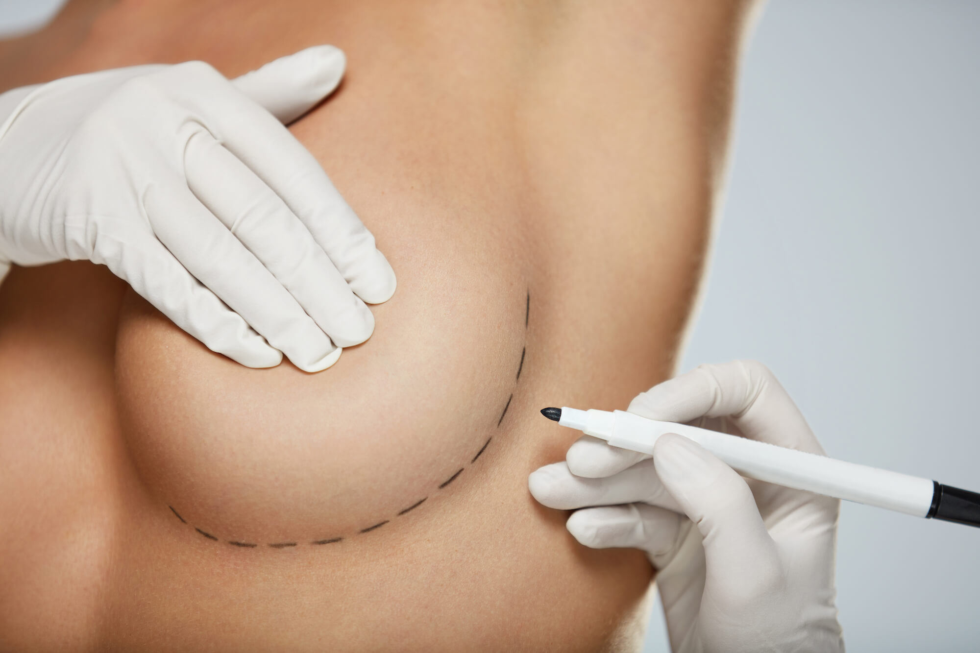 Line's Drawn on Woman's Breast in Preparation for and Augmentation or Reshaping Surgery