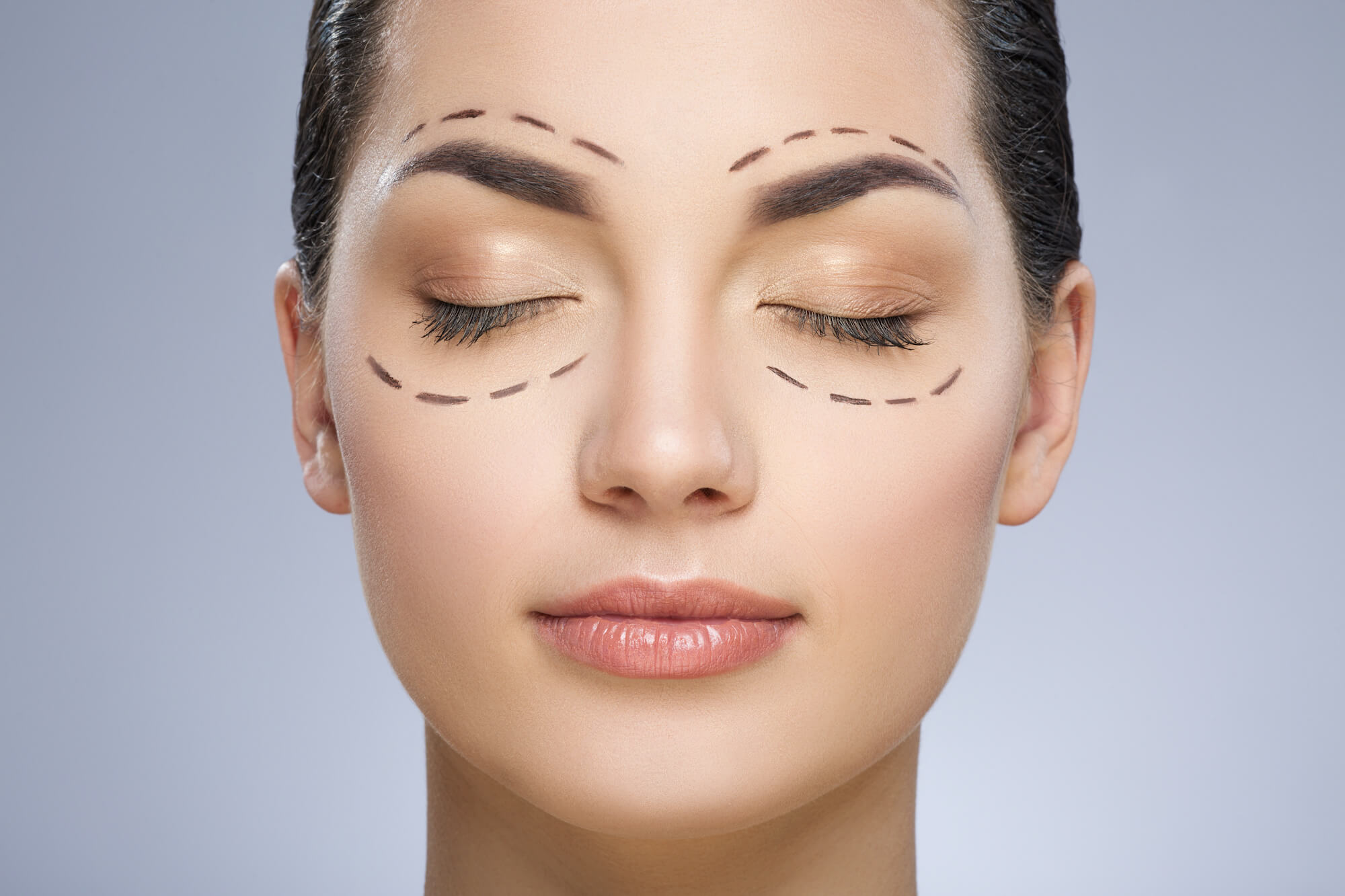 Woman's Face With Lines Drawn for Eyelid Surgery