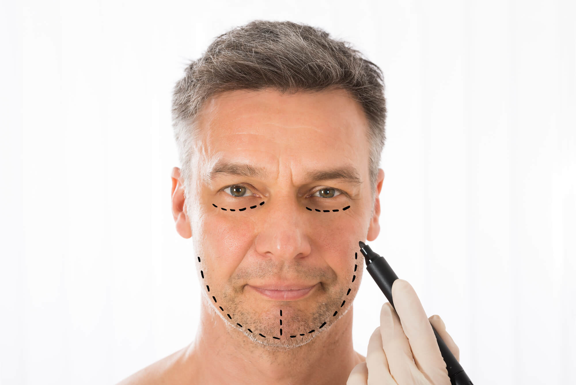 Man's Face With Lines Drawn for Facelift Surgery