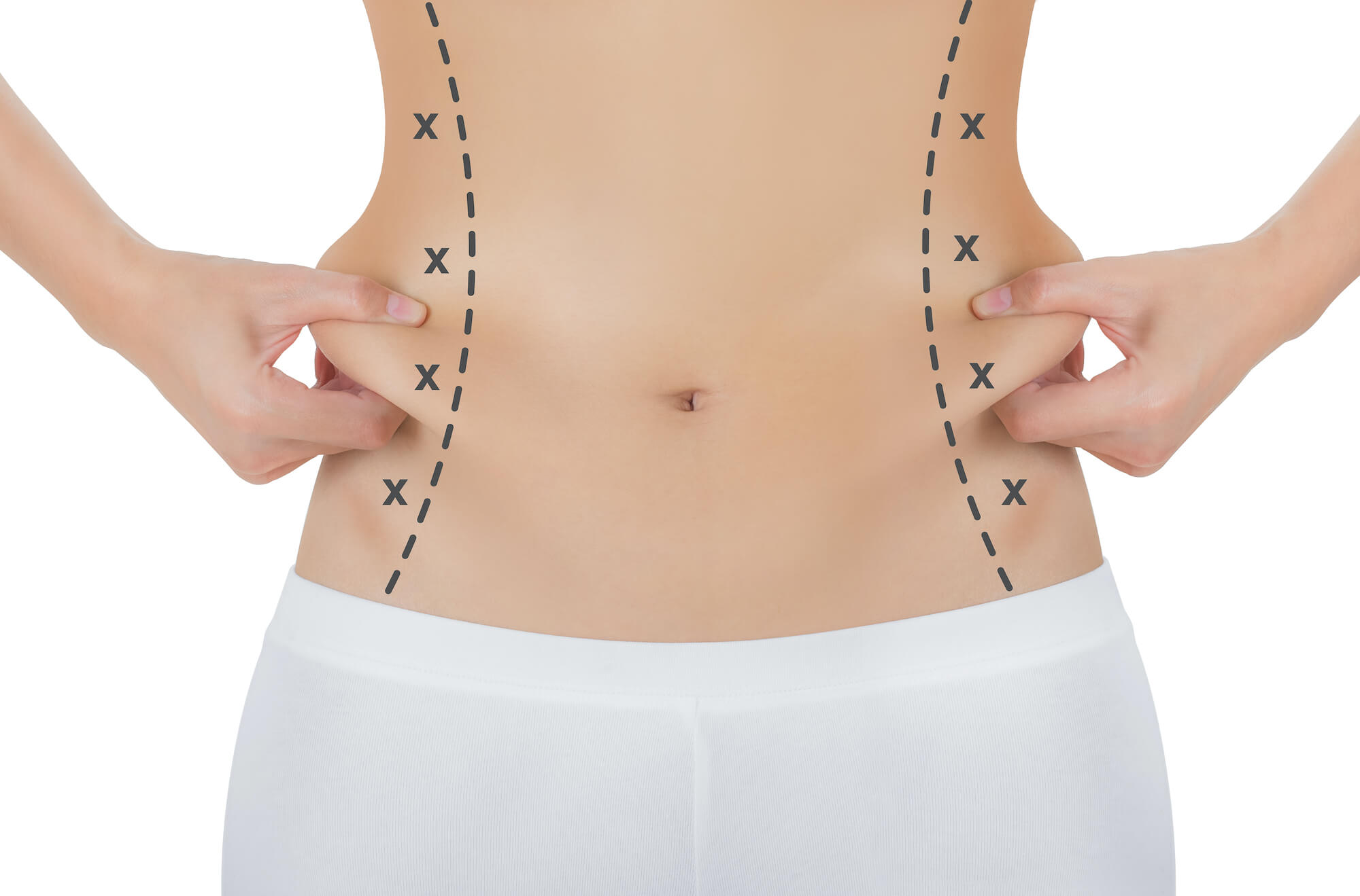 Woman's Abdomen With Lines Drawn for Liposuction Surgery