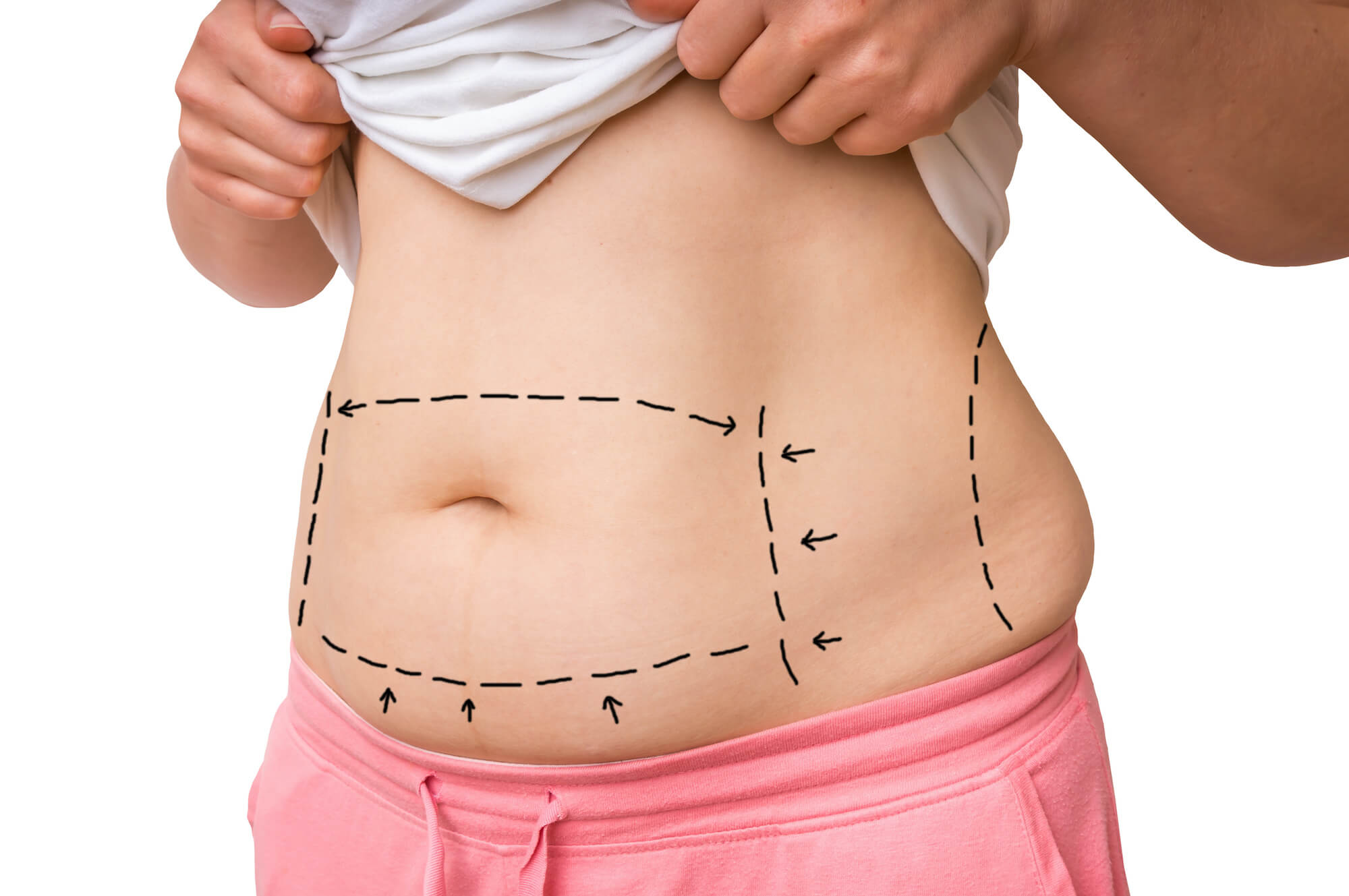 Woman With Lines on Her Stomach to Prep for Tummy Tuck Surgery